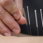 acupuncture-1